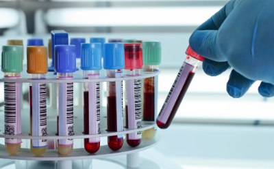 Blood samples fill a laboratory centrifuge A gloved hand places a test tube holding a blood sample into a plastic laboratory test tube rack holding other blood samples with various colored lids.